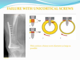 Thin cortices: choose screw diameter as large as
possible
Slide 86
FAILURE WITH UNICORTICAL SCREWS
 