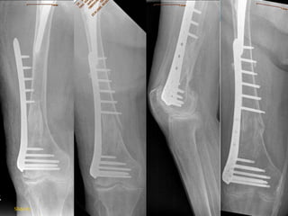 10 months
postop.
5 days later
Slide 87
 