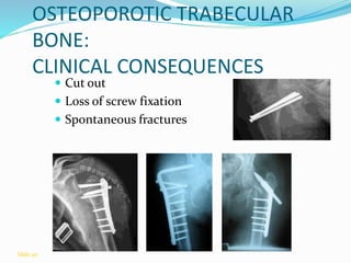 OSTEOPOROTIC TRABECULAR
BONE:
CLINICAL CONSEQUENCES
 Cut out
 Loss of screw fixation
 Spontaneous fractures
Slide 90
 