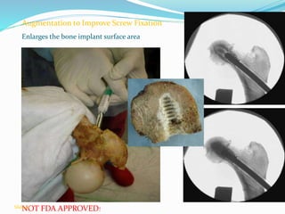 Augmentation to Improve Screw Fixation
Enlarges the bone implant surface area
NOT FDA APPROVED!Slide 91
 