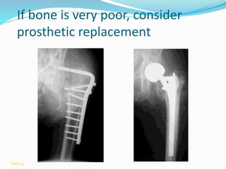 If bone is very poor, consider
prosthetic replacement
Slide 93
 