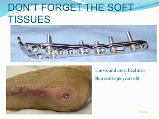 DON’T FORGET THE SOFT
TISSUES
The wound must heal also
Skin is also 98 years old
Slide 94
 