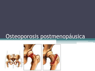 Osteoporosis postmenopáusica
 