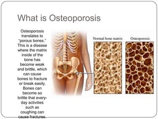 What is Osteoporosis
  Osteoporosis
  translates to
“porous bones.”
This is a disease
where the matrix
   inside of the
     bone has
 become weak
and brittle, which
    can cause
bones to fracture
 or break easily.
    Bones can
    become so
brittle that every-
  day activities
      such as
  coughing can
cause fractures.
 