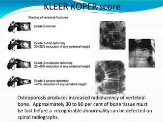 KLEER KOPER score
Osteoporosis produces increased radiolucency of vertebral
bone. Approximately 30 to 80 per cent of bone tissue must
be lost before a recognizable abnormality can be detected on
spinal radiographs.
 