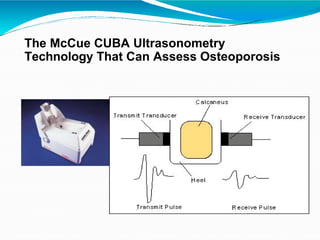 The McCue CUBA Ultrasonometry
Technology That Can Assess Osteoporosis
 
