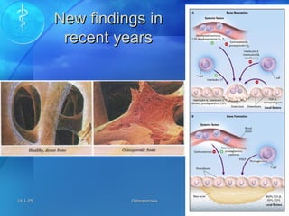 14.1.0514.1.05 OsteoporosisOsteoporosis 1010
New findings inNew findings in
recent yearsrecent years
 