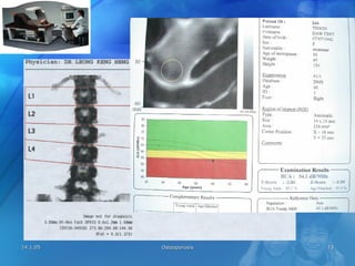 14.1.0514.1.05 OsteoporosisOsteoporosis 1313
BMDBMD
 