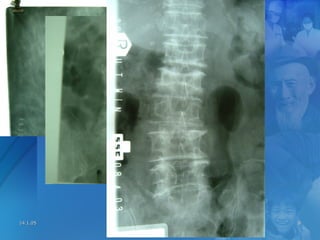 14.1.0514.1.05 OsteoporosisOsteoporosis 88
 