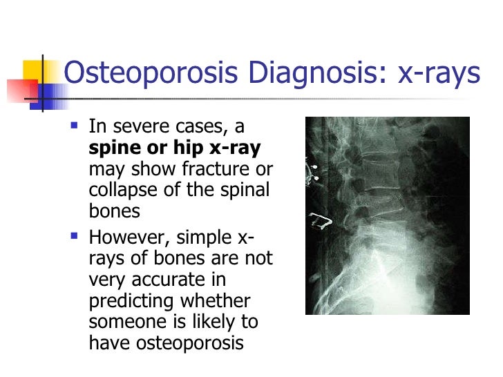 Osteoporosis Prevention And Management