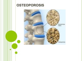 OSTEOPOROSIS
 