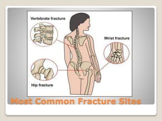 Most Common Fracture Sites
 