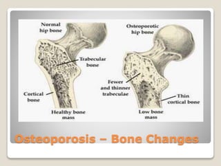 Osteoporosis – Bone Changes
 