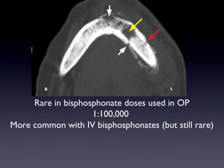 Rare in bisphosphonate doses used in OP
                    1:100,000
More common with IV bisphosphonates (but still rare)
 
