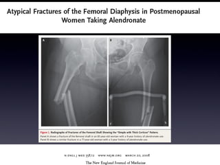 Osteoporosis talk july 2012 4 slideshare