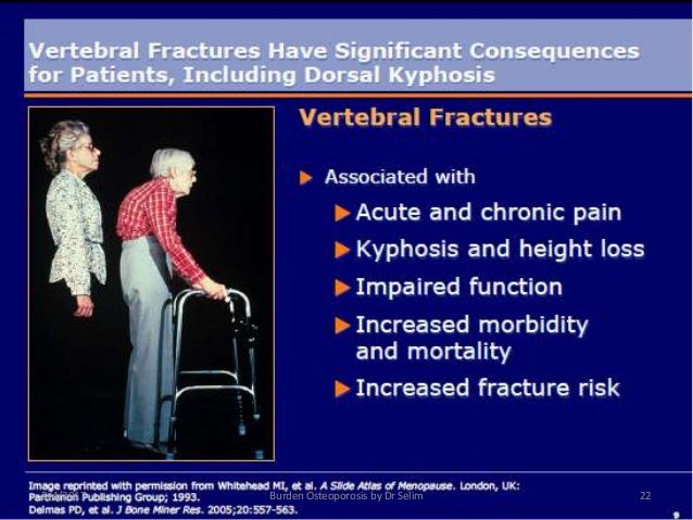 Osteoprosis Evaluation Management And Prevention By Dr Shahjada Sel