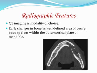 Radiographic Features
 CT imaging is modality of choice.
 Early changes in bone: is well defined area of bone
resorption within the outer cortical plate of
mandible.
 