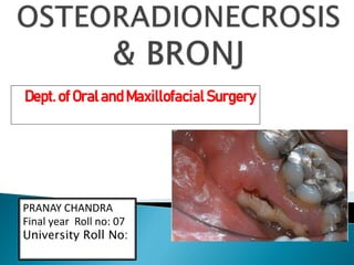 OSTEORADIONECROSIS &BRONJ-1 assignment.pptx