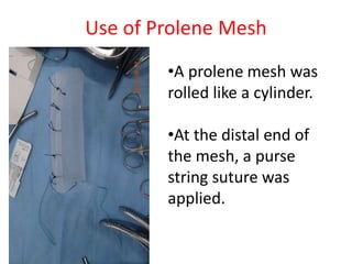 Prolene Purse String Limb salvage surgery in osteosarcoma- clinical meeting | PPTX