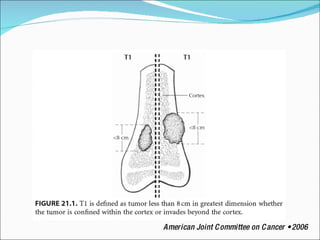 American Joint Committee on Cancer • 2006 