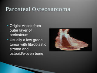  Origin: Arises from
outer layer of
periosteum
 Usually a low grade
tumor with fibroblastic
stroma and
osteoid/woven bone
 