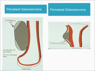 Parosteal Osteosarcoma Periosteal Osteosarcoma
 