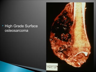  High Grade Surface
osteosarcoma
 