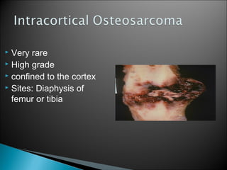  Very rare
 High grade
 confined to the cortex
 Sites: Diaphysis of
femur or tibia
 