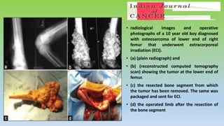 • radiological images and operative
photographs of a 10 year old boy diagnosed
with osteosarcoma of lower end of right
femur that underwent extracorporeal
irradiation (ECI).
• (a) (plain radiograph) and
• (b) (reconstructed computed tomography
scan) showing the tumor at the lower end of
femur.
• (c) the resected bone segment from which
the tumor has been removed. The same was
packaged and sent for ECI.
• (d) the operated limb after the resection of
the bone segment
 