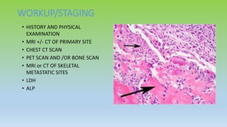 WORKUP/STAGING
• HISTORY AND PHYSICAL
EXAMINATION
• MRI +/- CT OF PRIMARY SITE
• CHEST CT SCAN
• PET SCAN AND /OR BONE SCAN
• MRI or CT OF SKELETAL
METASTATIC SITES
• LDH
• ALP
 