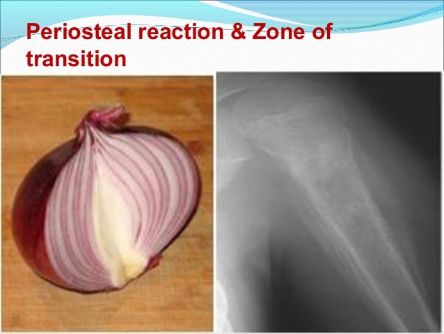Osteosarcoma (knee joint)