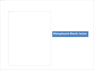 Metaphysial Blastic lesion
 