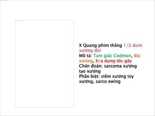 X Quang phim thẳng 1/2 dưới
xương đùi
Mô tả: Tam giác Codman, đặc
xương, h/a dựng tóc gáy
Chẩn đoán: sarcoma xương
tạo xương
Phân biệt: viêm xương tủy
xương, sarco ewing
 