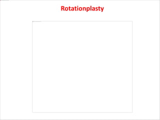 Rotationplasty
 