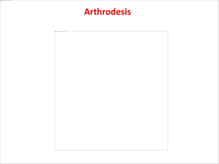 Arthrodesis
 