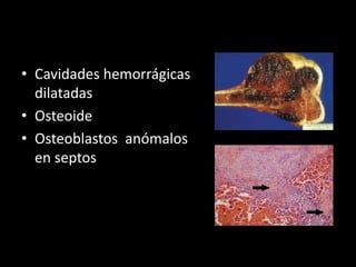 • Cavidades hemorrágicas
dilatadas
• Osteoide
• Osteoblastos anómalos
en septos
 