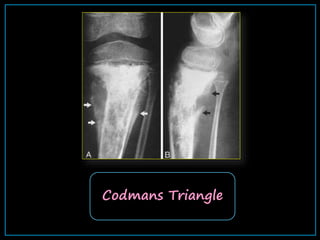 osteosarcoma.ppt