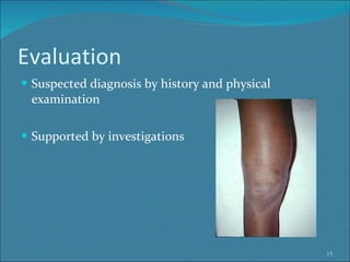 Evaluation Suspected diagnosis by history and physical examination Supported by investigations 