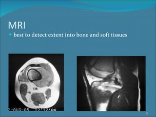 MRI  best to detect extent into bone and soft tissues 