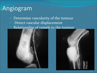 Angiogram Determine vascularity of the tumour Detect vascular displacement Relationship of vessels to the tumour 