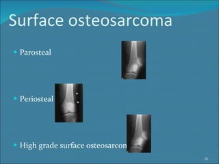 Surface osteosarcoma Parosteal Periosteal High grade surface osteosarcoma 