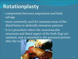 Rotationplasty compromise between amputation and limb salvage most commonly used for osteosarcomas of the distal femur in skeletally immature patients It is a procedure where the neurovascular structures and distal aspect of the limb (leg) are retained, and re-attached to the proximal portion after the tumor has been removed.  