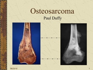 Osteosarcoma Paul Duffy 