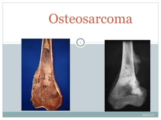 Osteosarcoma
    1




               04/23/13
 