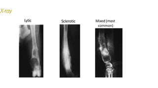 X-ray
Sclerotic
Lytic Mixed (most
common)
 