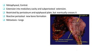  Metaphyseal, Central.
 Extension into medullary cavity and subperiosteal extension.
 Restricted by periosteum and epiphyseal plate, but eventually crosses it
 Reactive periosteal new bone formation
 Metastasis –lungs
8
 