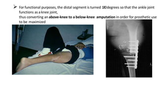  For functional purposes, the distal segment is turned 180degrees so that the ankle joint
functions as a knee joint,
thus converting an above-knee to a below-knee amputation in order for prosthetic use
to be maximized
 