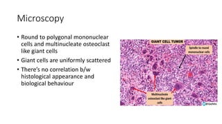 Microscopy
• Round to polygonal mononuclear
cells and multinucleate osteoclast
like giant cells
• Giant cells are uniformly scattered
• There’s no correlation b/w
histological appearance and
biological behaviour
 
