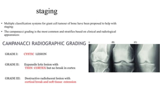 staging
• Multiple classification systems for giant cell tumour of bone have been proposed to help with
staging:
• The campanacci grading is the most common and stratifies based on clinical and radiological
appearances:
 