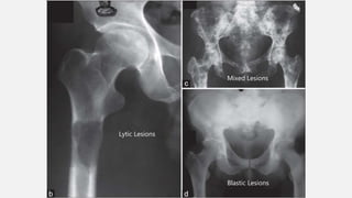 Lytic Lesions
Mixed Lesions
Blastic Lesions
 